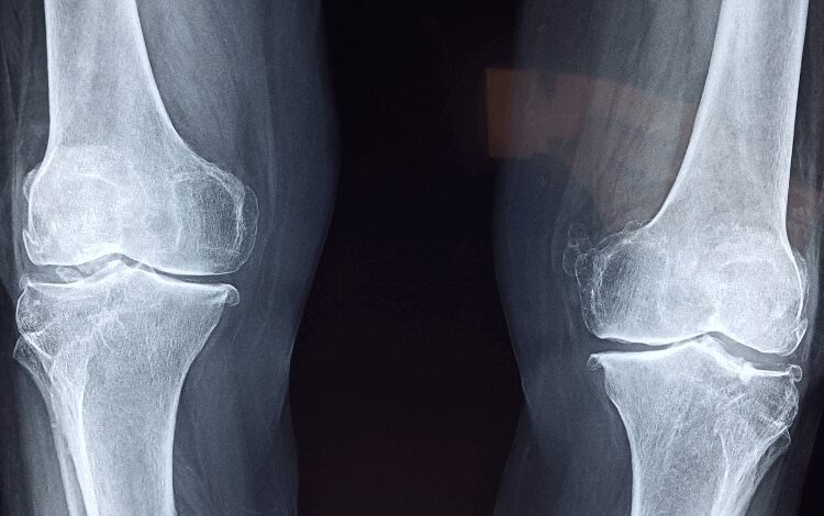 Approaches to Address Pain Beyond Painkillers Approaches to Address Pain Beyond Painkillers